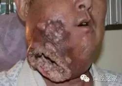據(jù)報道，一位因嚼檳榔長達10年而患上口腔癌的博主不幸離世。，咀嚼檳榔與口腔癌的發(fā)生之間存在密切關(guān)系。檳榔中含有的化學(xué)物質(zhì)會對口腔黏膜造成損傷，長期咀嚼檳榔容易導(dǎo)致口腔黏膜病變，從而引發(fā)口腔癌。因此，應(yīng)該引起足夠的重視，避免長時間咀嚼檳榔，保持健康的生活方式。，此外，對于已經(jīng)患病的人群，應(yīng)該及早發(fā)現(xiàn)、診斷和治療，避免病情惡化。同時，也要呼吁大家關(guān)注口腔健康，定期進行口腔檢查，及時發(fā)現(xiàn)并治療口腔疾病。，總之，我們應(yīng)該以健康為中心，遠離不良的生活習(xí)慣，保持健康的生活方式，預(yù)防疾病的發(fā)生。