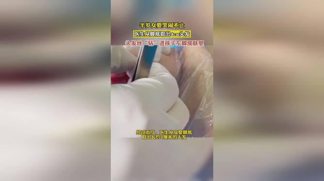 是的，有時(shí)候很小的細(xì)節(jié)問(wèn)題也可能導(dǎo)致嬰兒不適和哭鬧。頭發(fā)絲繞腳趾可能會(huì)引起疼痛或不適，導(dǎo)致嬰兒哭鬧不止。如果您發(fā)現(xiàn)這種情況發(fā)生，請(qǐng)仔細(xì)檢查嬰兒的腳趾，看看是否有頭發(fā)或其他細(xì)線纏繞在腳趾或皮膚上。如果有，請(qǐng)小心地將其解開，并確保徹底清潔嬰兒的腳部以避免任何感染的風(fēng)險(xiǎn)。同時(shí)，為了避免這種情況再次發(fā)生，建議定期檢查嬰兒的衣物和周圍環(huán)境，確保沒有任何可能導(dǎo)致嬰兒不適的小物品或細(xì)節(jié)問(wèn)題。如果您對(duì)嬰兒的哭鬧感到擔(dān)憂，建議盡快聯(lián)系醫(yī)生或?qū)で髮I(yè)的醫(yī)療建議。
