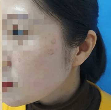 年輕人熬夜會長老年斑？流言
